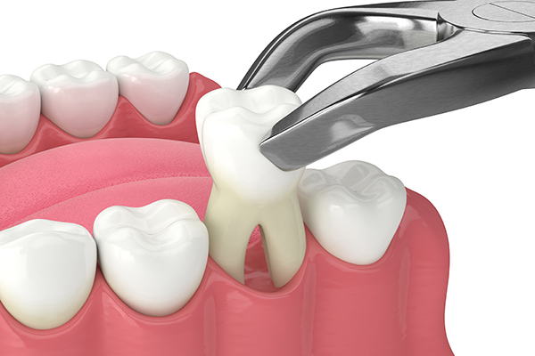 General Dentistry Reasons For Tooth Extractions